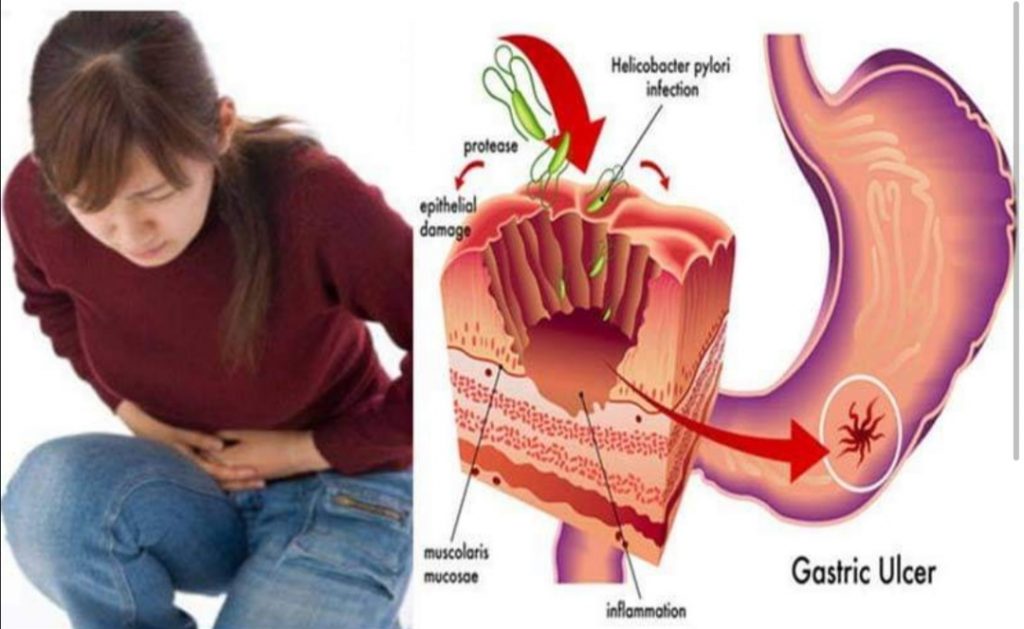 ग्यास्ट्रिकको समस्या छ भने यी ६ घरेलु उपाय