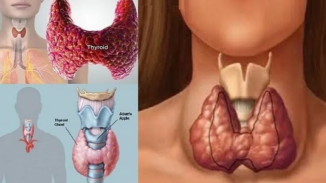 थाइराइड हुँदा के खाने के नखाने ? लक्षण के के हुन् ? कसरी उपचार गर्ने ?