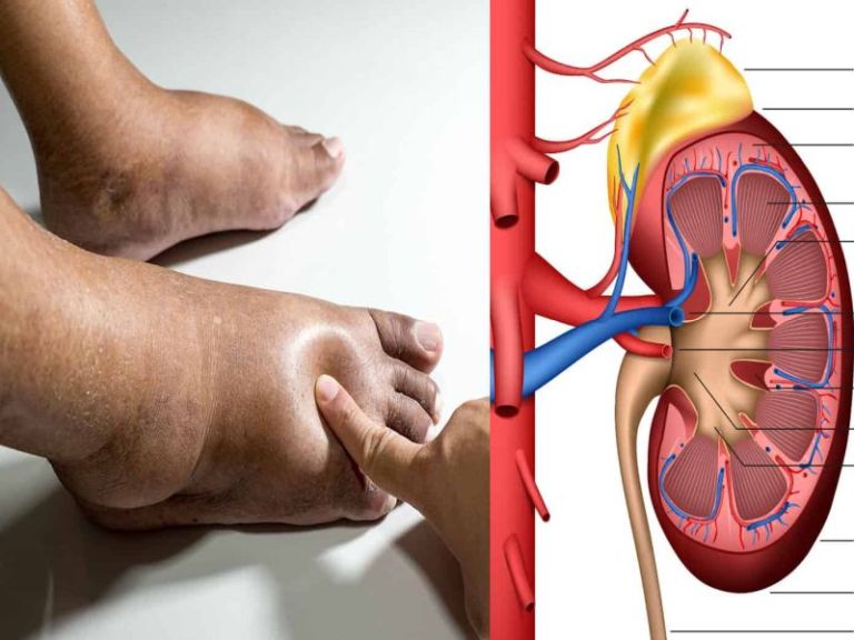 यी हुन् मृगौला फेल हुन लागेका प्रारम्भिक संकेतहरु,जानीराखौं